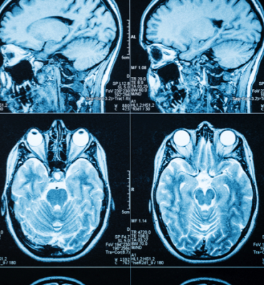 ENFERMAGEM EM NEUROLOGIA